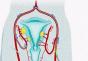 Embolization of the uterine arteries for uterine fibroids and heavy bleeding