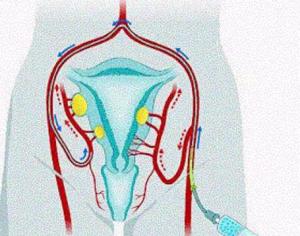 자궁 근종 및 과다 출혈을 위한 자궁 동맥 색전술