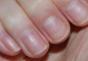 Why do longitudinal stripes appear on the nails?