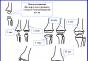 Tuberculose des os et des articulations